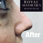 Royal-Aesthetics-Nose-Job-5-After