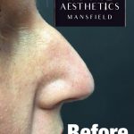 Royal-Aesthetics-Nose-Job-5-Before