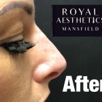 Royal-Aesthetics-Nose-Job-6-After