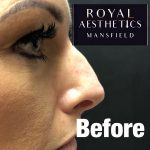 Royal-Aesthetics-Nose-Job-6-Before