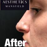 Royal-Aesthetics-Nose-Job-7-After