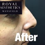 Royal-Aesthetics-Nose-Job-8-After