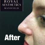 Royal-Aesthetics-Nose-Job-9-After
