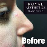 Royal-Aesthetics-Nose-Job-9-Before