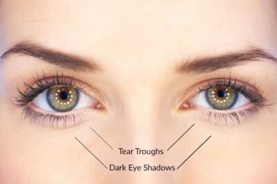 Tear-Troughs-Dark-Eye-Shadow
